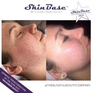 Microdermabrasion Facial Treatment. Image credits to The Blissful Beauty Company.